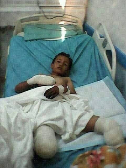 صورة أرشيفية لطفل يمني أصيب بالإعاقة جراء انفجار لغم حوثي في البيضاء